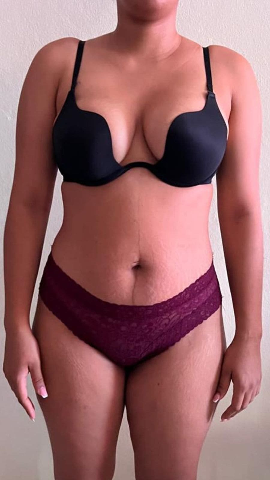 Mommy Makeover en RD. Dr Christian Caceres. Cirujano Plastico en Republica Dominicana (7)